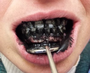Activated charcoal slurry on teeth
